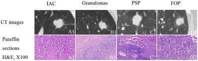 Corrigendum: Convolutional neural network-based diagnostic model for a solid, indeterminate solitary pulmonary nodule or mass on computed tomography